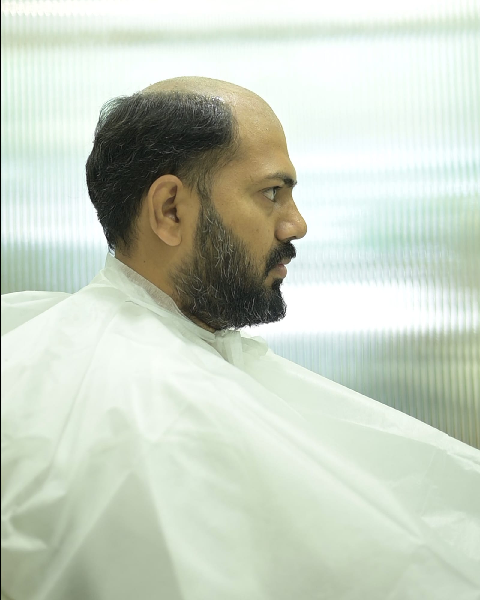 Before — hair loss from the hairline through to the crown, seen in profile
