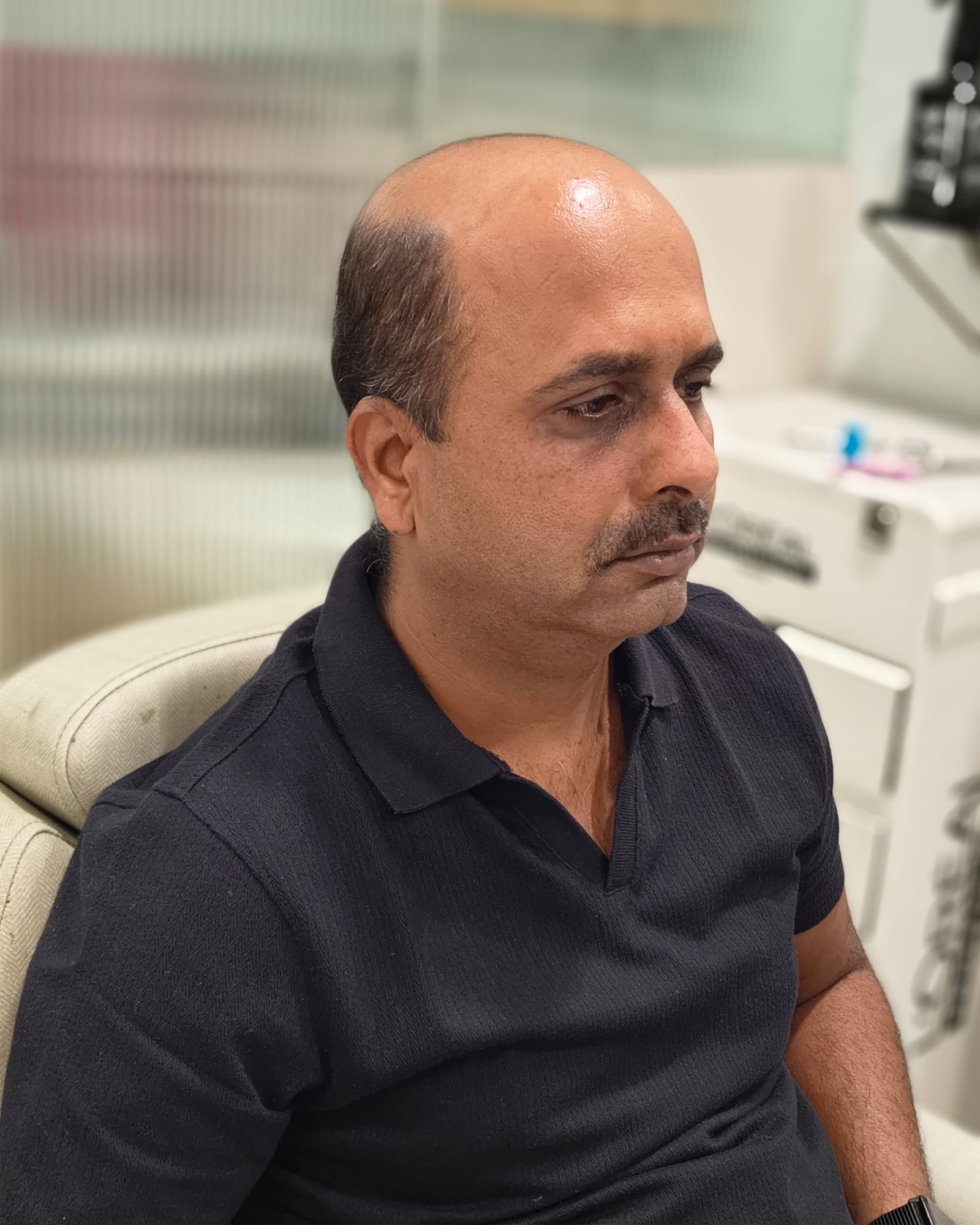 Before — bald from the front through the crown, with greying hair at the sides