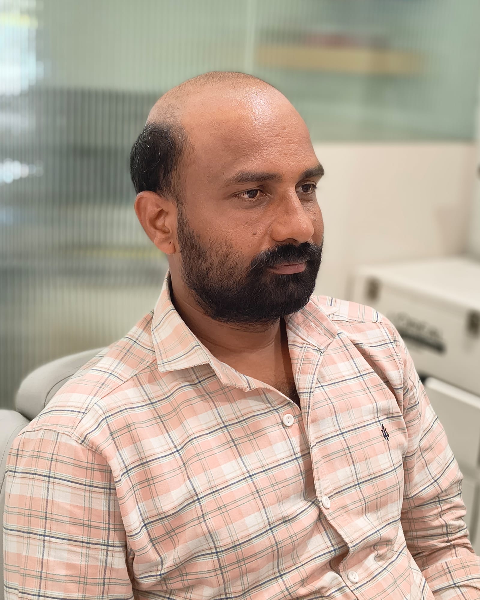 Before — extensive hair loss across the top of the scalp