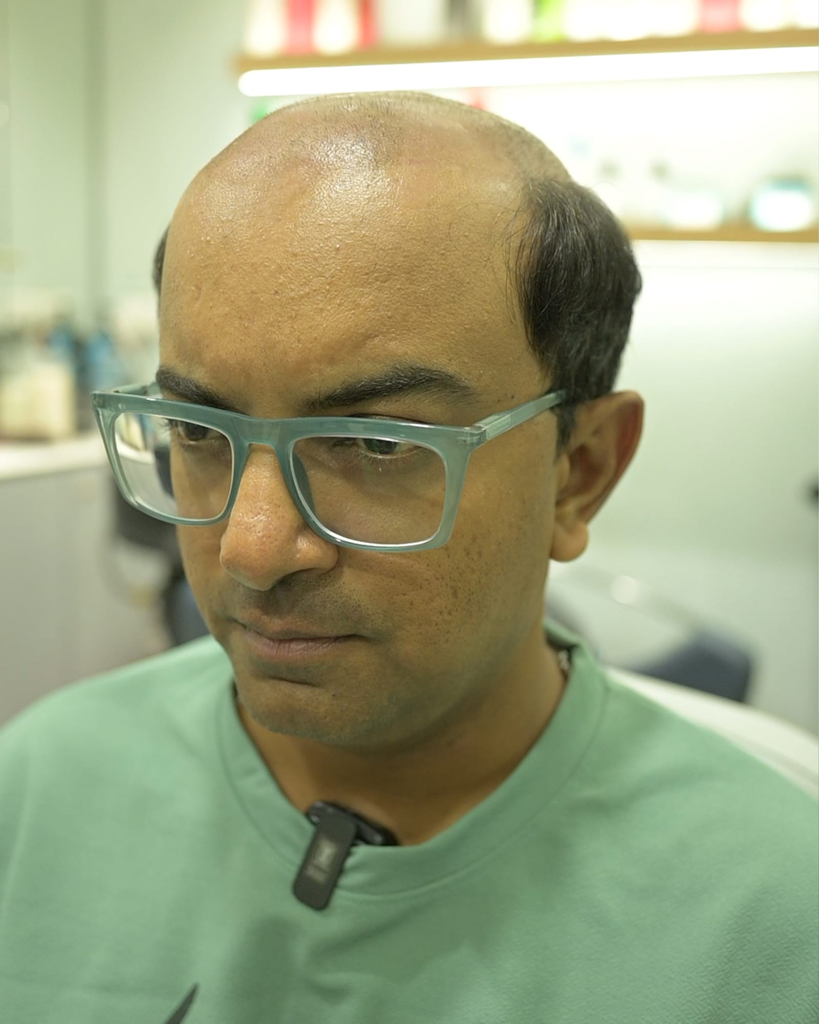 Before — thinning hair across the top and crown, head tilted forward
